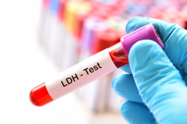 Laktat dehidrogenaza (LDH)