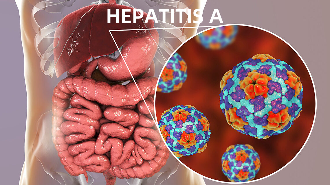 Hepatitis A