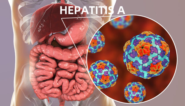 Hepatitis A