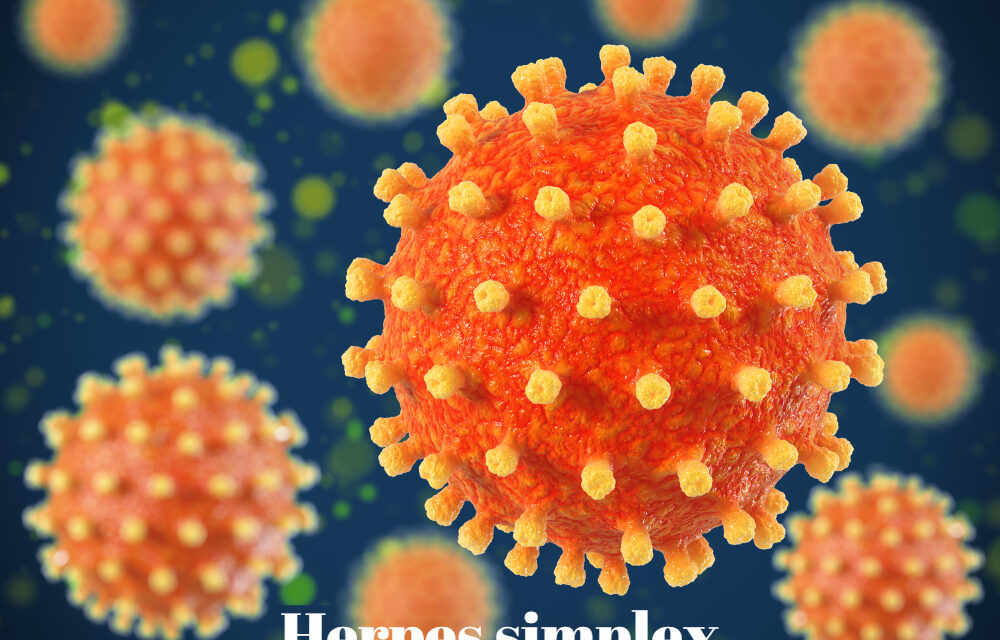 Herpes simplex