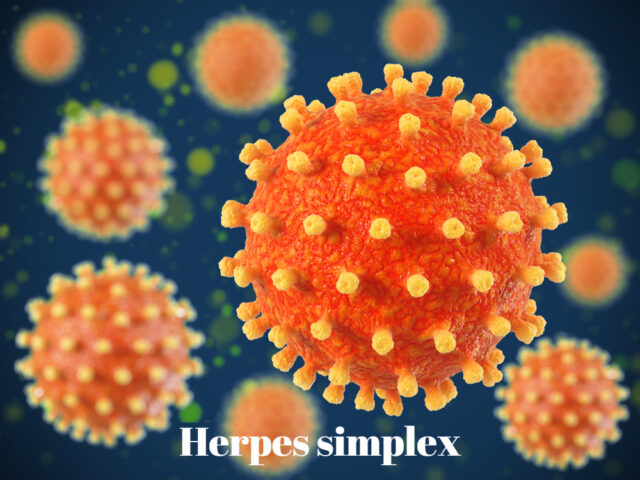 herpes simplex