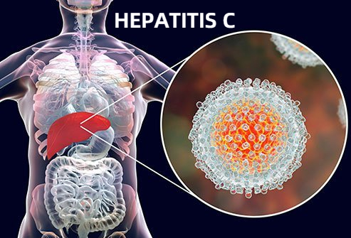 Hepatitis C